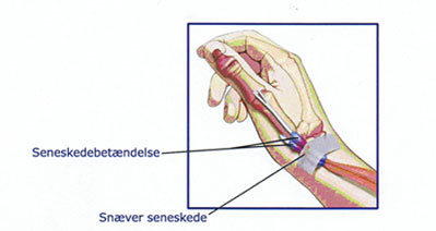 SENESKEDE